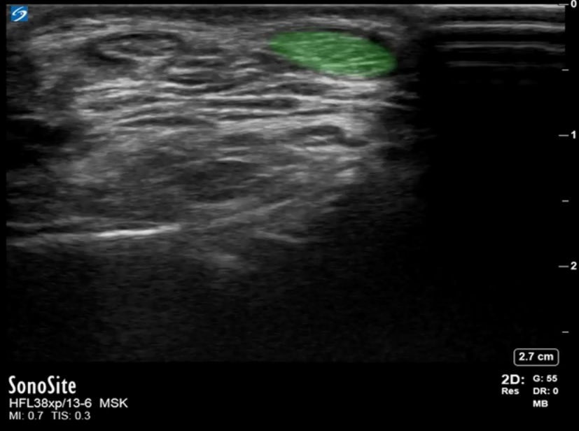 Foot Ankle Anterior Recess Tibialis Anterior Image Sonosite